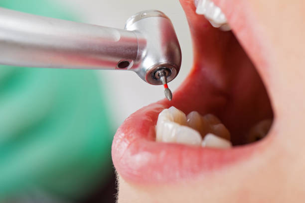 Best Emergency Wisdom Tooth Extraction in El Paso, TX
